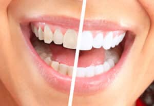 teeth whitening plano