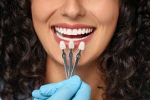 dental veneers plano